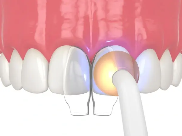 dental bonding in abbotsford, bc