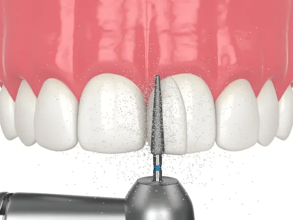 dental bonding near you