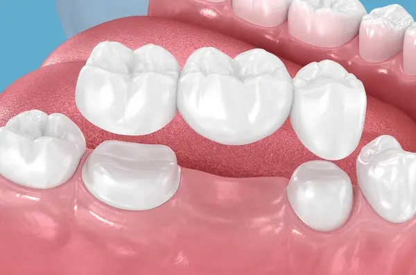 dental bridges in abbotsford, bc