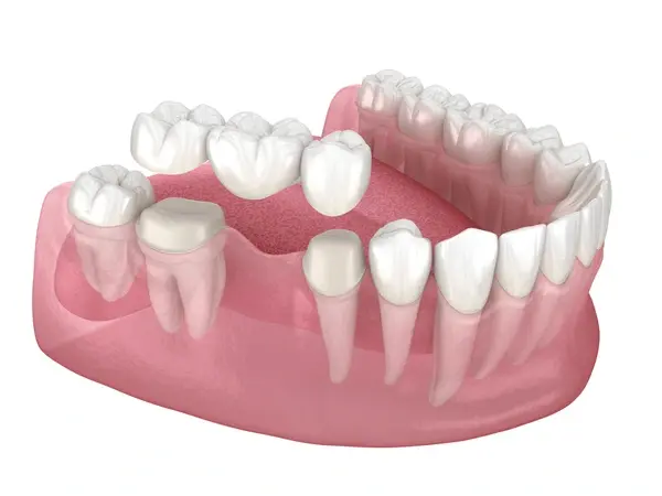 dental bridges near you