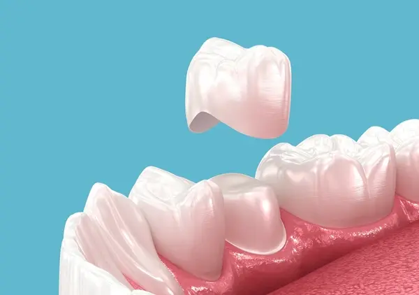 dental crowns in abbotsford, bc