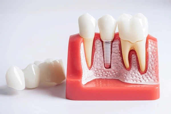 dental implants near you