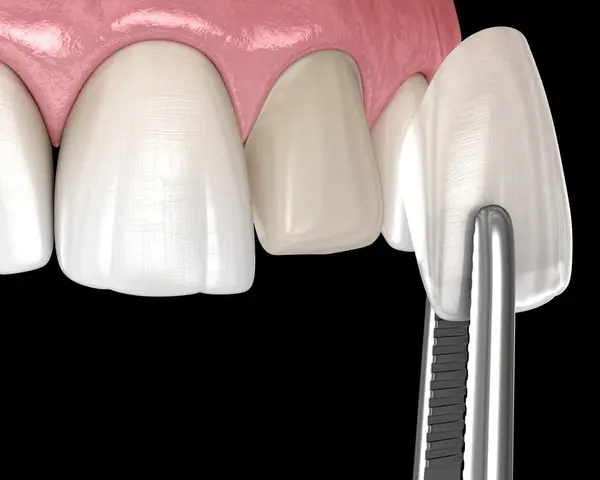 dental veneers in abbotsford, bc
